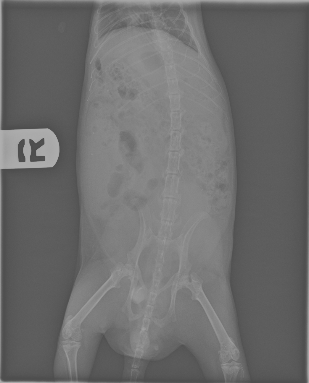 Kidney Stones: Prevention, Treatment, and When to Go to the ER