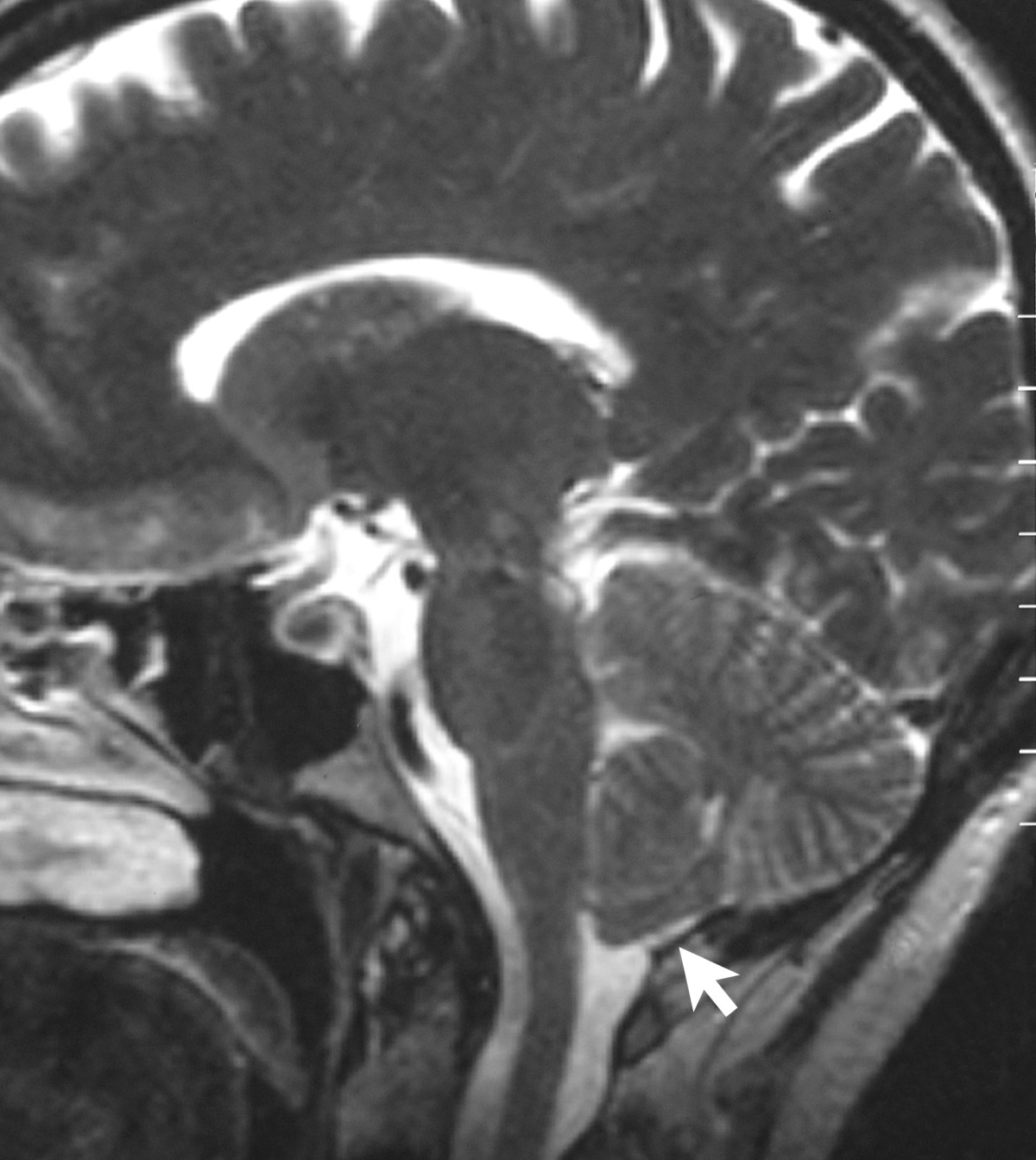 MRI Report Second Opinion AI: Get Your Scan Explained in Plain English